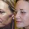 What Can Fotona 4D Do For Your Face?